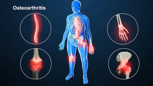 Melawan Kaku: Studi Mengonfirmasi Olahraga Sebagai Obat Utama Pereda Nyeri Osteoartritis