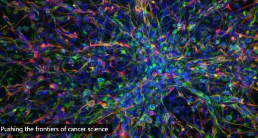 Harapan Baru Kanker Anak: Imunoterapi Kini Mampu Menembus Pertahanan Tumor Otak