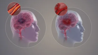 Uji Klinis Skala Besar Buktikan Alat AI Mampu Tingkatkan Kualitas Perawatan dan Tekan Risiko Kekambuhan Pasien Stroke