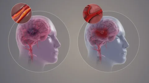 Uji Klinis Skala Besar Buktikan Alat AI Mampu Tingkatkan Kualitas Perawatan dan Tekan Risiko Kekambuhan Pasien Stroke