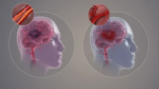 Uji Klinis Skala Besar Buktikan Alat AI Mampu Tingkatkan Kualitas Perawatan dan Tekan Risiko Kekambuhan Pasien Stroke