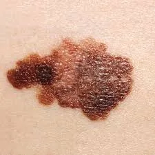Melanoma: AI Tunjukkan Hasil Menjanjikan, Namun Penggunaannya di Dunia Nyata Masih Timbulkan Pertanyaan