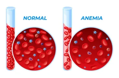 Waspada! Anemia Dapat Meningkatkan Risiko Demensia hingga 66% dan Memperburuk Biomarker Alzheimer