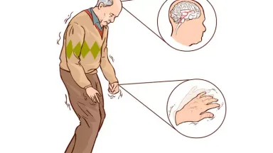 Penyakit Parkinson: Perubahan Bakteri Usus Muncul Bertahun-tahun Sebelum Gejala Fisik Terdeteksi