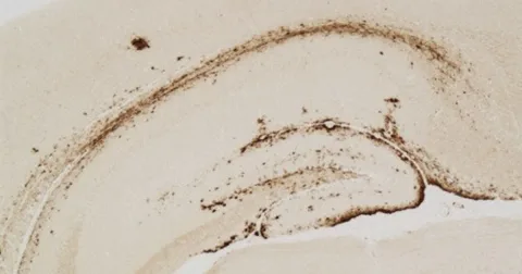 Ilmuwan Jepang Temukan 'Bibit' Pemicu Alzheimer yang Bisa Ditekan
