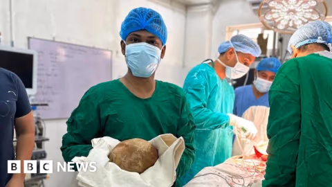 Rekor Medis: Dokter Sri Lanka Angkat Batu Kandung Kemih 3,1 Kg, Terbesar yang Pernah Tercatat