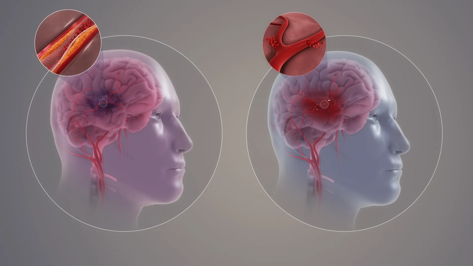 Uji Klinis Skala Besar Buktikan Alat AI Mampu Tingkatkan Kualitas Perawatan dan Tekan Risiko Kekambuhan Pasien Stroke