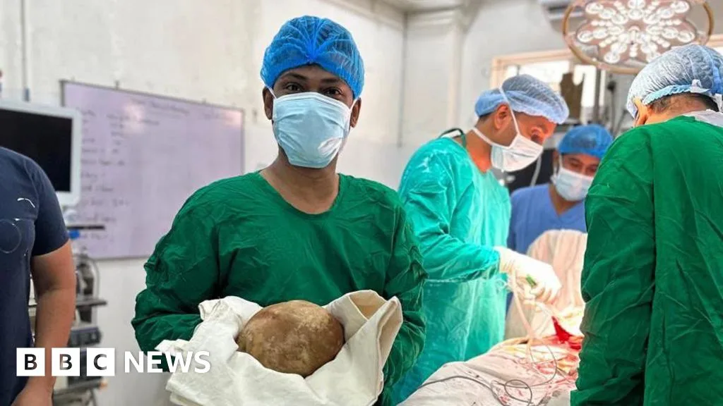 Rekor Medis: Dokter Sri Lanka Angkat Batu Kandung Kemih 3,1 Kg, Terbesar yang Pernah Tercatat